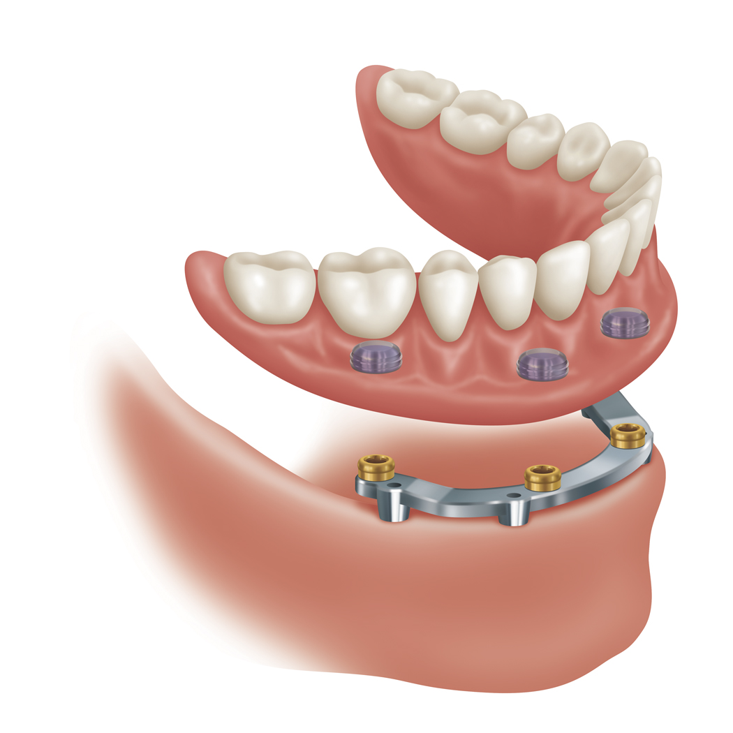 Zest LOCATOR Bar Attachment Zest Dental Solutions